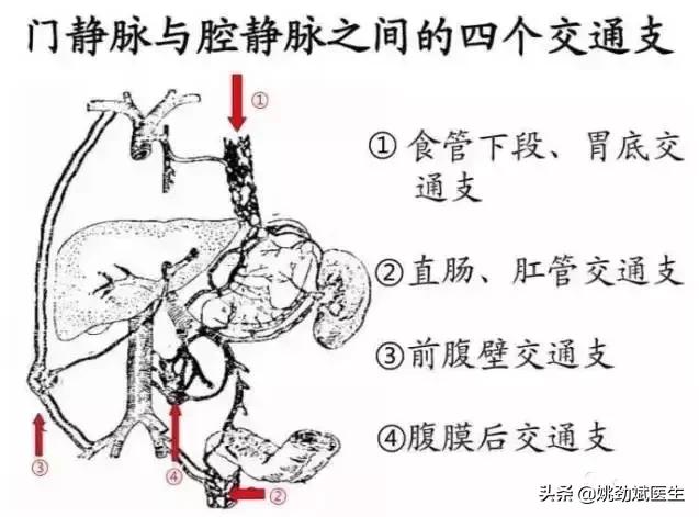 痔疮是肝硬化引起的吗,肝硬化痔疮出血