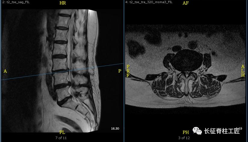 老年人腰椎管狭窄可以微创手术吗,老年人腰椎管狭窄瘫痪