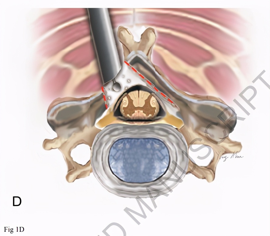 颈椎内窥镜手术效果,颈椎病内窥镜手术