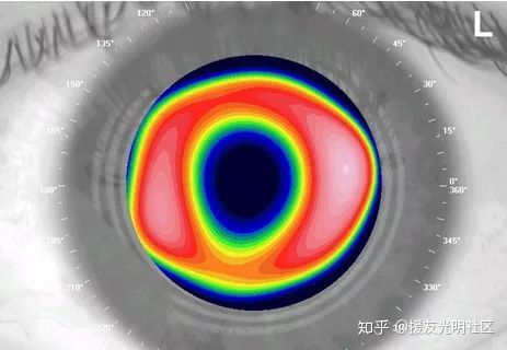 凹凸透镜矫正视力原理讲解,如何校正高阶像差