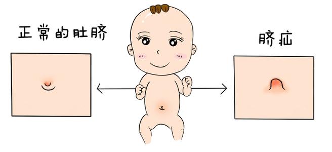 脐疝|孩子肚脐凸出来，要怎么处理