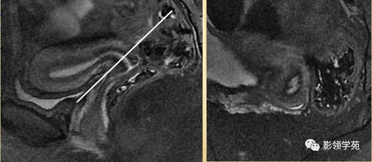 宫颈癌mri诊断,宫颈癌的mr扫描技术