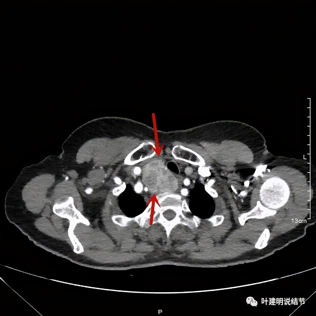 胸部高分辨ct检查注意事项,胸部ct扫描有没有危害