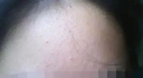 小孩眼睛周围的脂肪粒怎么去除,眼睛周围的脂肪粒怎么快速消除