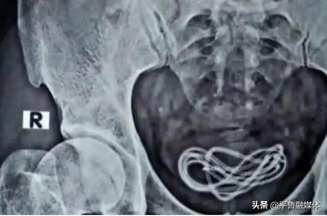 数据线居然在男子体内?这是怎么了?医生的猜测让我无语了