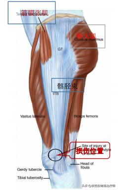 老生常谈跑步膝:髂胫束综合征(ITBS)