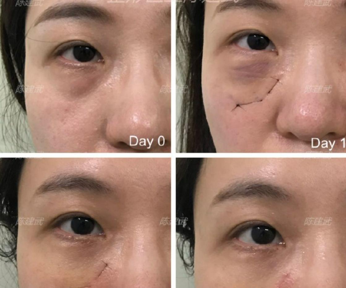 去眼袋泪沟医美方法,想了解一下去眼袋的最佳方法