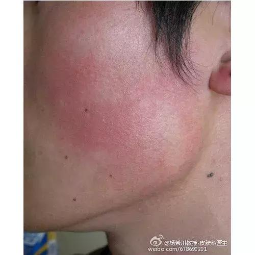 鸡皮肤夏天会好一些吗,夏天鸡皮肤解决方法