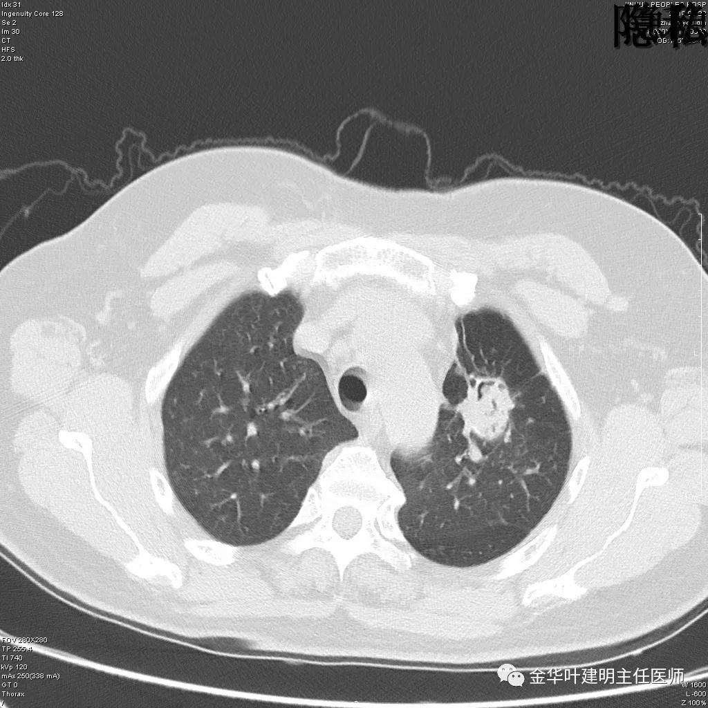 左肺下叶恶性病变,左肺上叶和下叶都有血管畸形