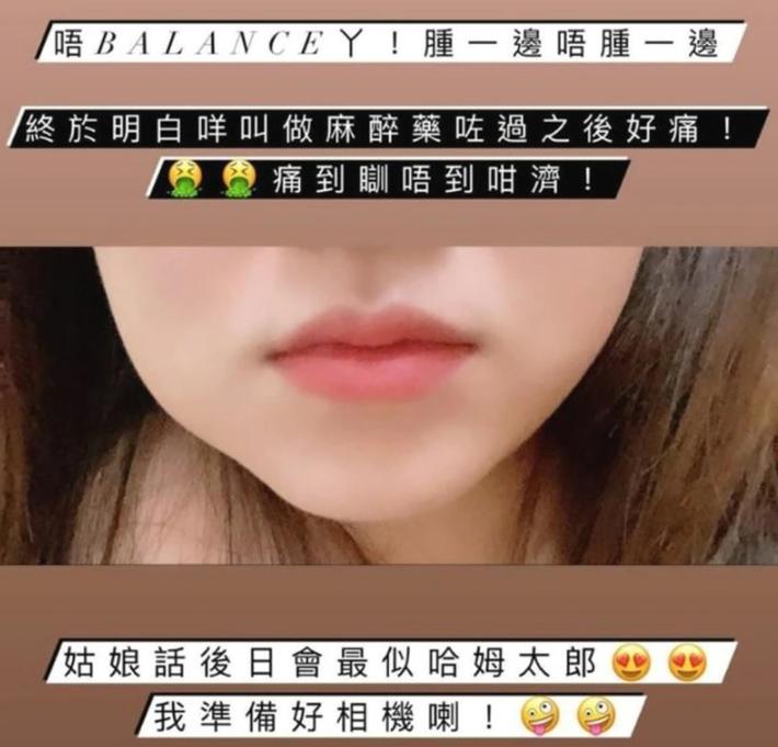 26岁女星江嘉敏拔牙后药物过敏，导致全身瘙痒，腿上长满小疙瘩