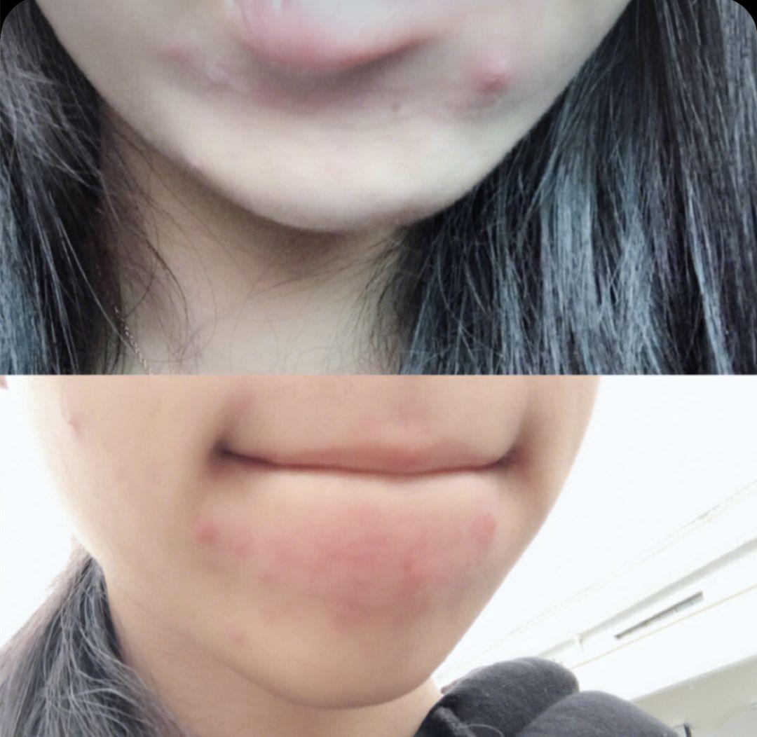 超好用的祛痘膏便宜,有没有好用的祛痘膏推荐女孩子