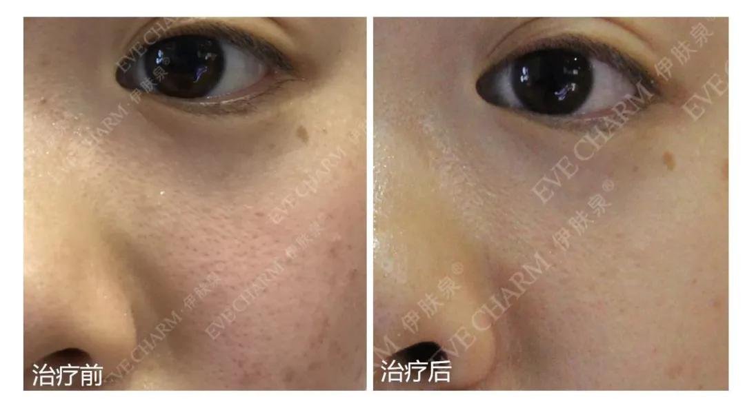 先破后立原理的美容仪有哪些,微针一般治疗以后多久恢复