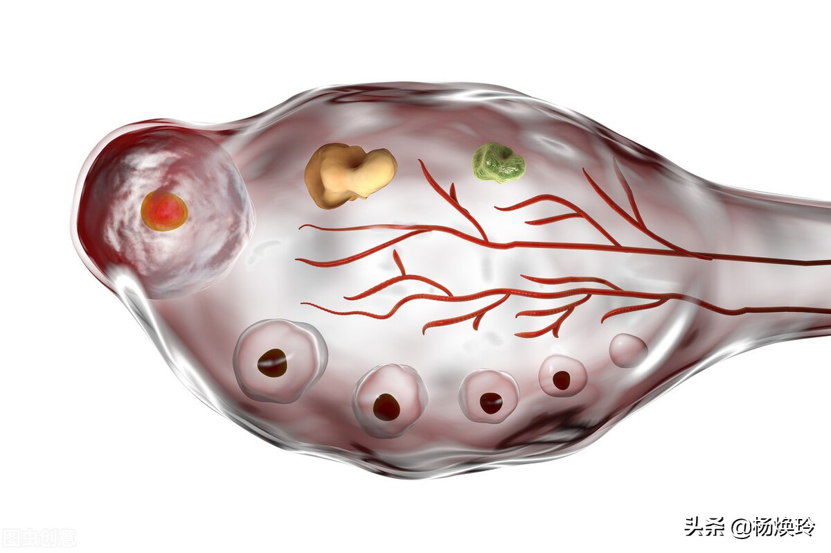 诊间日记-小李多囊,遗传惹的祸