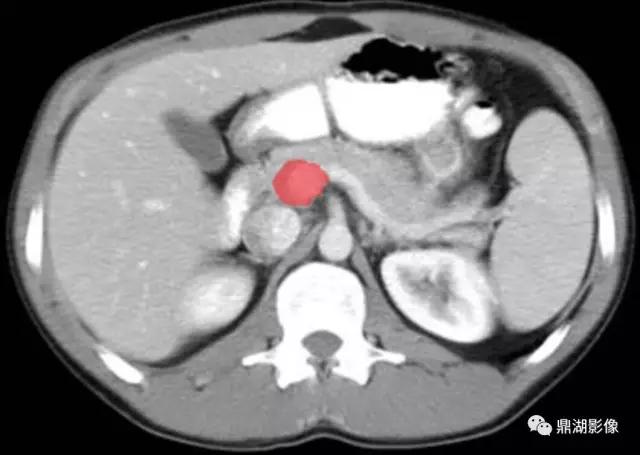 颈部胸锁乳突肌ct断层解剖图,骨盆骨质正常断层ct解剖图解