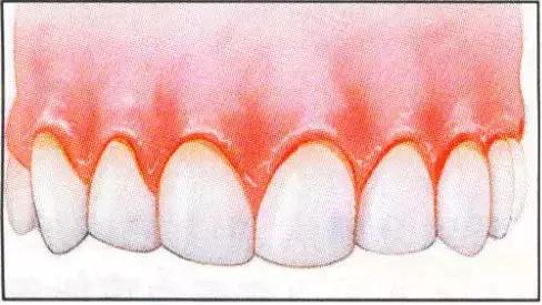肝硬化的牙龈出血和牙龈炎的区别,牙龈出血牙龈炎验方