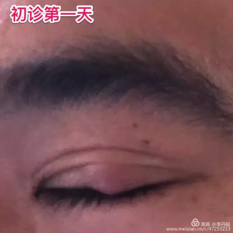 针眼用什么偏方去掉,民间治疗针眼神奇的方法