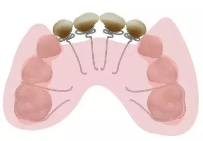 什么叫地包天怎么治疗,什么叫地包天能矫正吗
