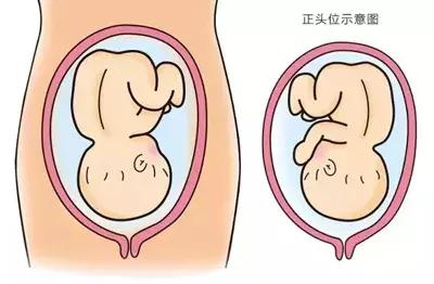 顺产要不要挨剪刀,顺产怎么才可以避免侧切