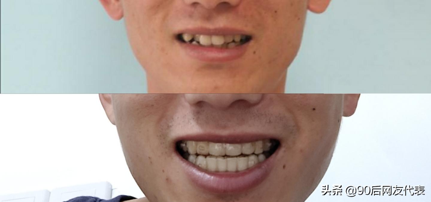 因为牙齿不齐自卑,你的牙齿是否也是如此不齐