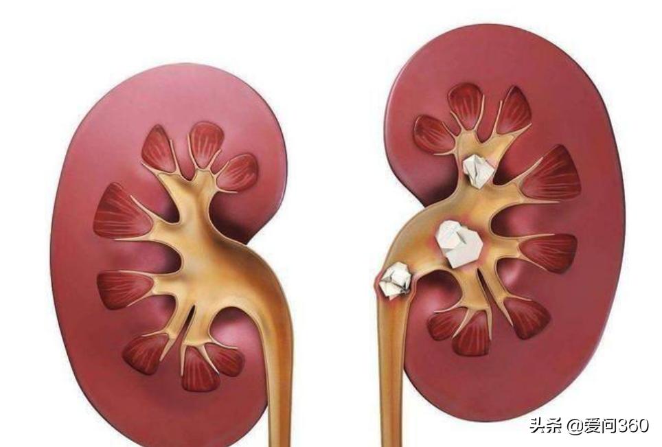 肾结石通常是什么原因造成的,肾结石是怎么形成的有什么方法