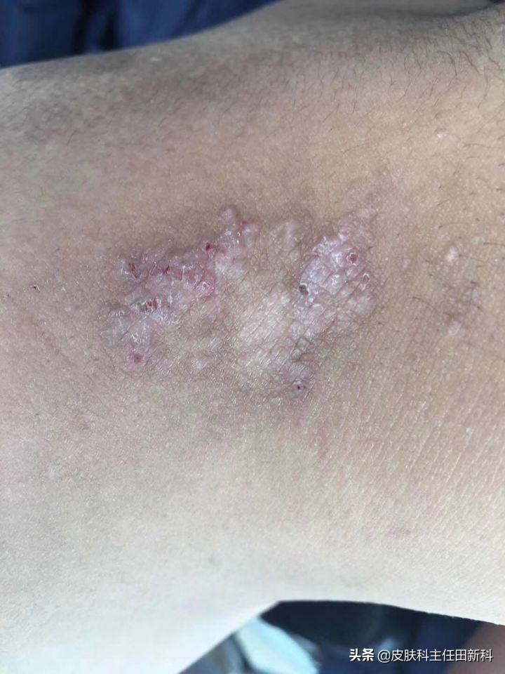 真菌感染性皮肤病原因,人真菌皮肤病怎么治