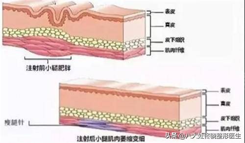 瘦脸针瘦腿针瘦肩针该怎么选,瘦肩针跟瘦脸针是不是一样的
