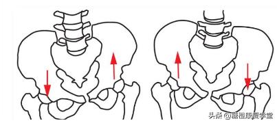 骨盆倾斜与脊柱侧弯还有这种联系？（1）