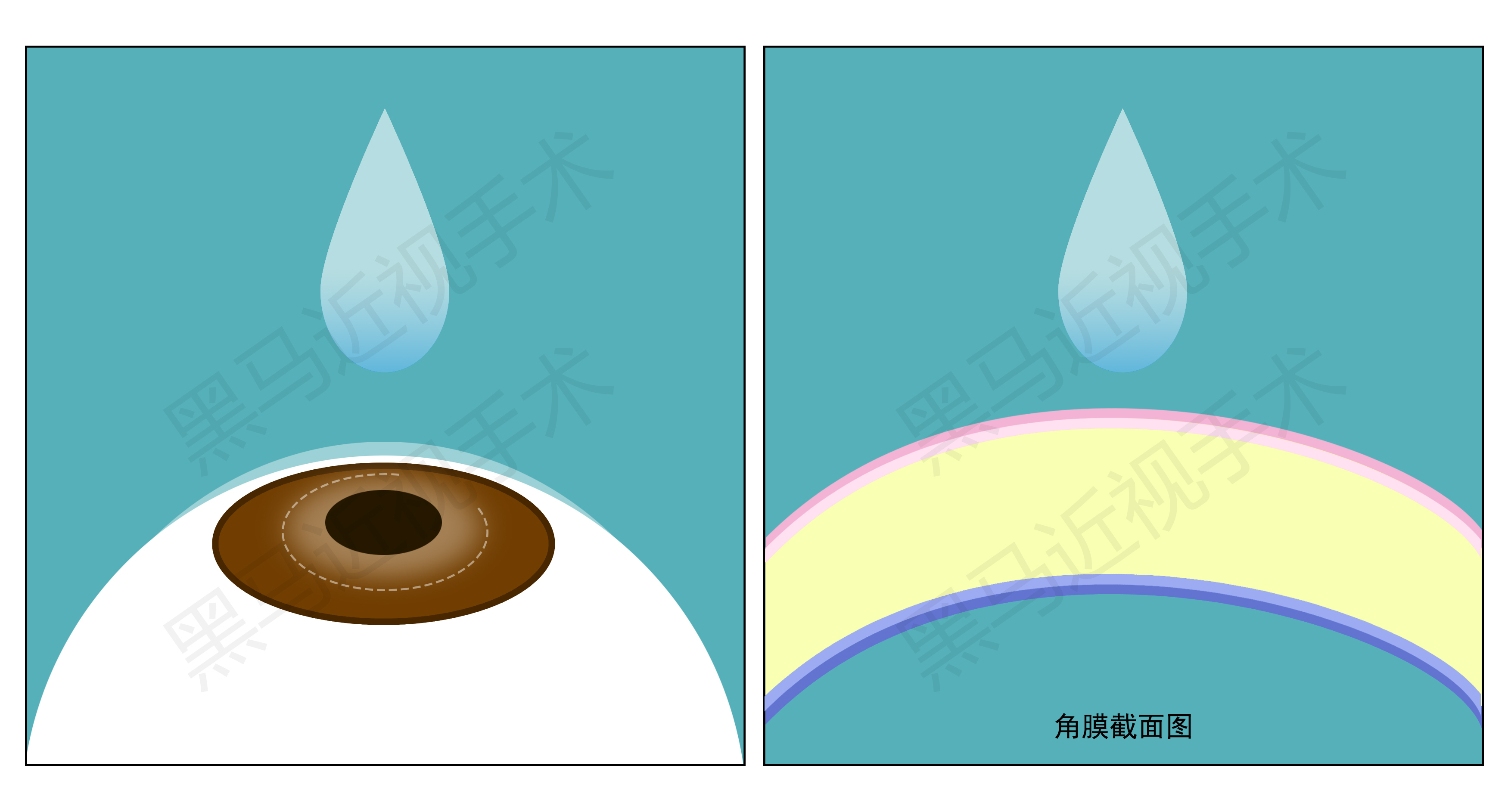 激光近视矫正手术有什么后遗症,激光治疗近视安全啊有没有后遗症