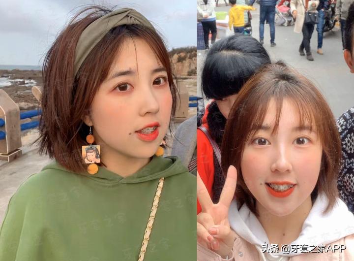 不靠整容怎么改变下巴后缩?看这里