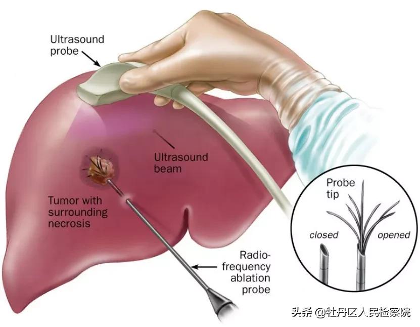 赵英俊肝癌做手术了吗,赵英俊肝癌做了手术没有