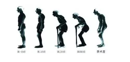 强直性脊柱炎可以做广播体操吗,一起来做广播操