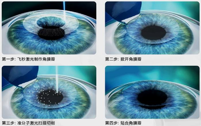 苏州明基医院眼科靠谱吗,苏州明基医院好还是公立医院好