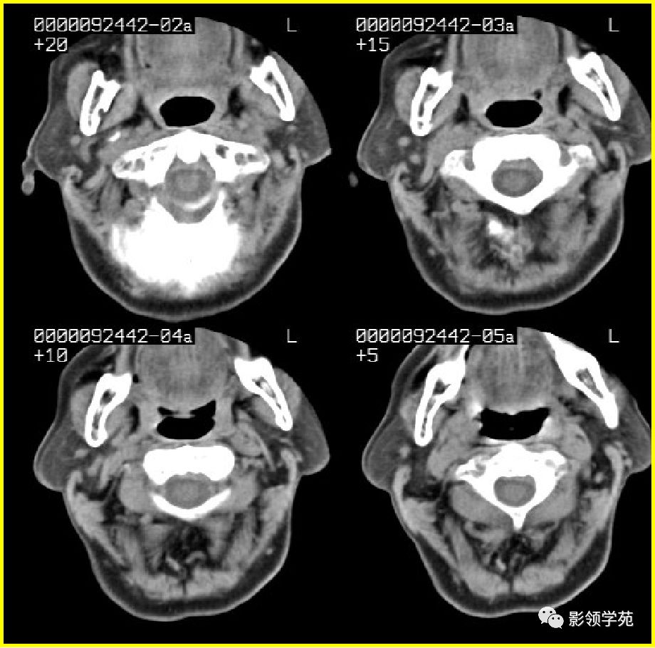 腮腺疾病影像学诊断,腮腺肿块影像诊断
