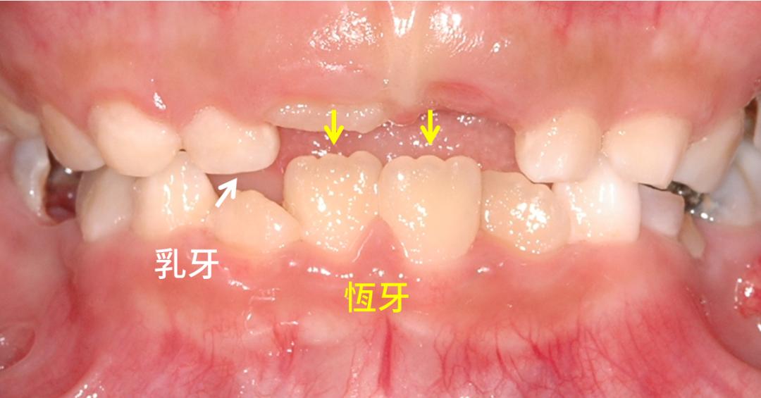 姚晨的牙齿怎么回事,姚晨育儿全过程