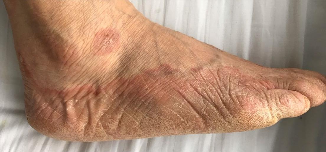 手足癣干裂脱皮怎么治,湿疹和手足癣如何一起治疗