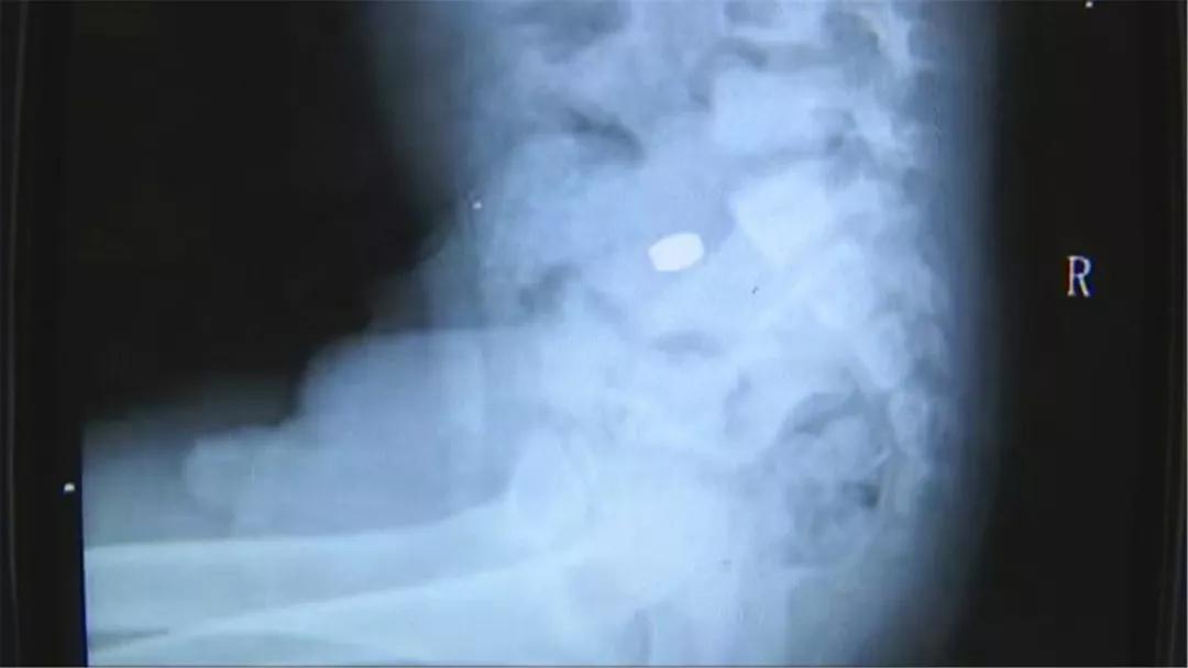 4岁男孩吃了它，体内充血水肿糜烂！快把家中这个东*藏西**好