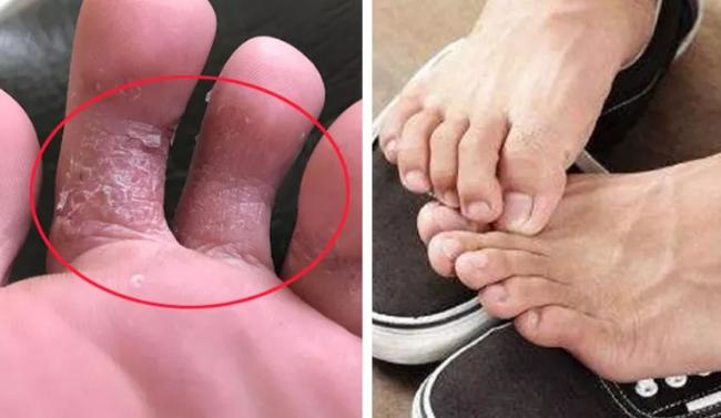 一招教你解决脚后跟干裂起皮,治理脚后跟干裂脱皮的小妙招