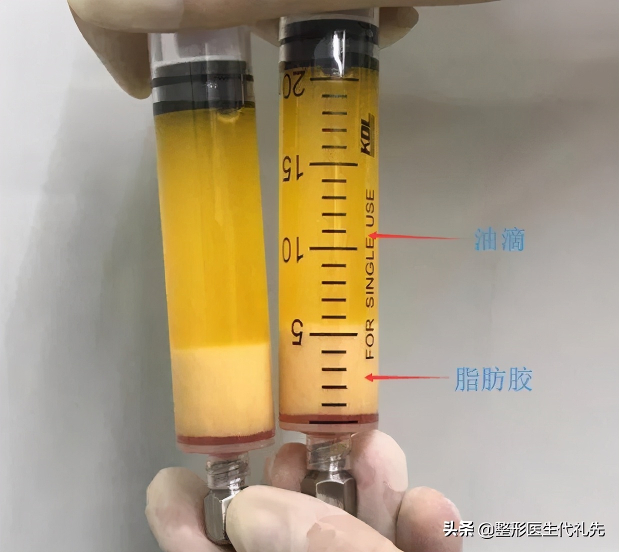 眼袋脂肪去除过多眼睛凹陷,做完眼袋下睑凹陷严重怎么办