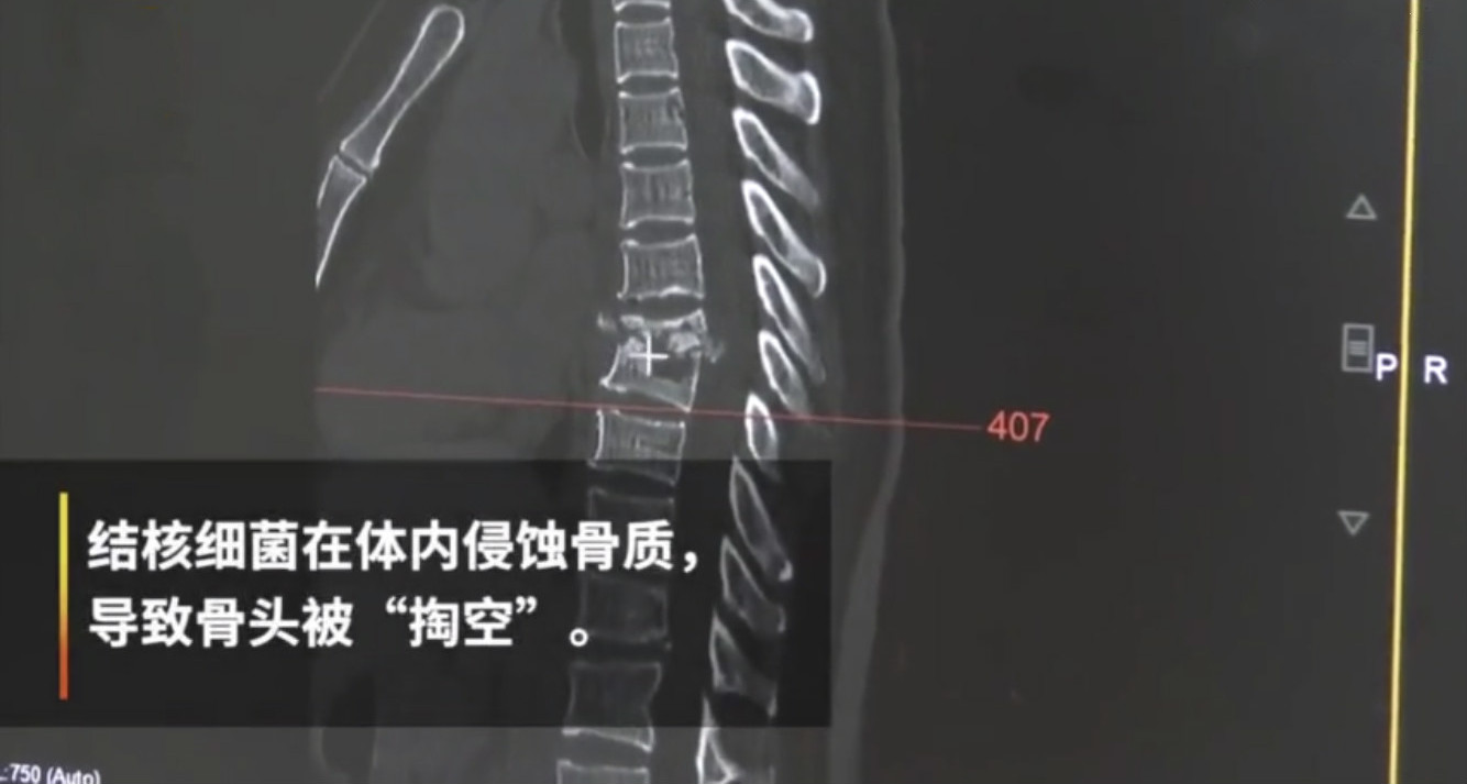 腰背疼痛当心骨质疏松,腰背痛或是骨质疏松