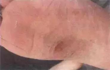 科普真菌感染性皮肤病的防治,专门治疗真菌皮肤病的药膏