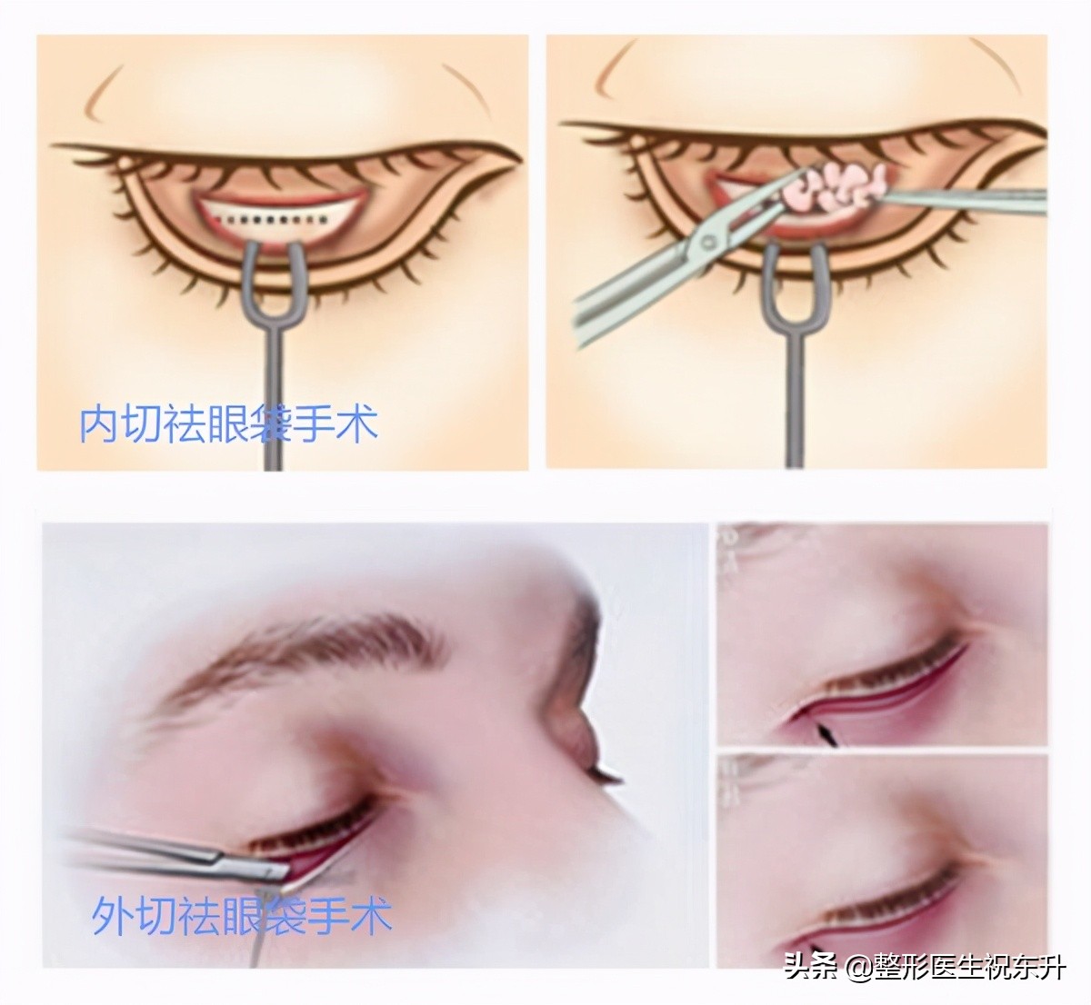 医生科普祛黑眼圈眼袋,祛眼袋医生怎么说