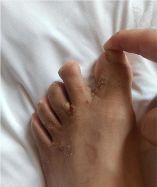 什么是脚气得了脚气怎么快速消除,脚气和真正的脚气病有什么区别