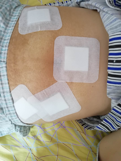 和平医院做息肉病理多少钱,和平医院做子宫肌瘤怎么样