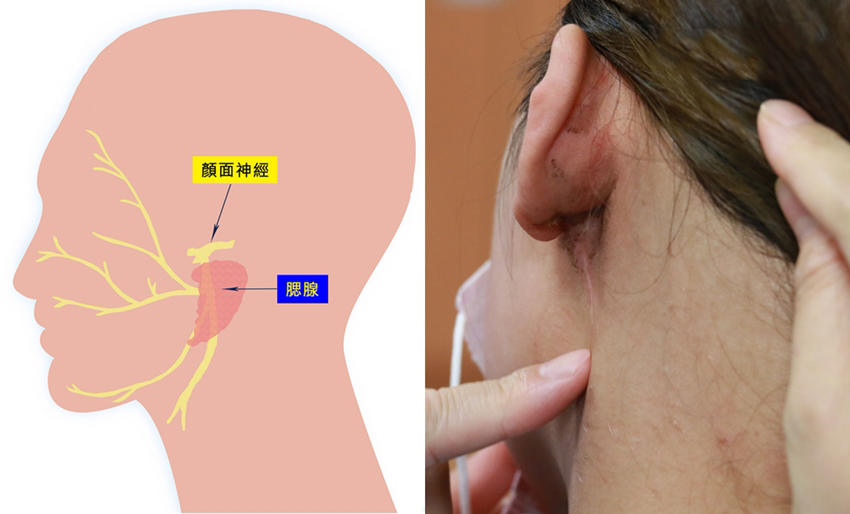 岳云鹏耳朵后面起的包是什么,耳朵边上起包了什么原因