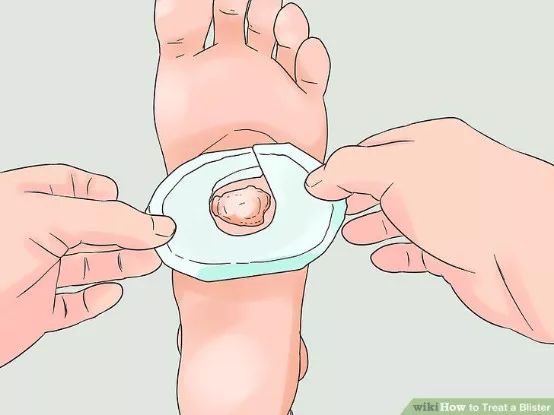 怎么预防跑步起水泡,一到夏天跑步脚就起泡怎么办