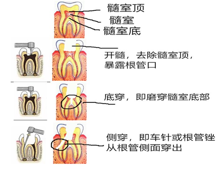 做根管治疗有没有风险,做根管治疗诱发癌症