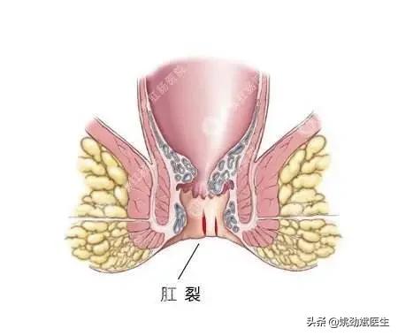 肛裂出血怎么治疗,宝宝肛裂如何正确处理呢
