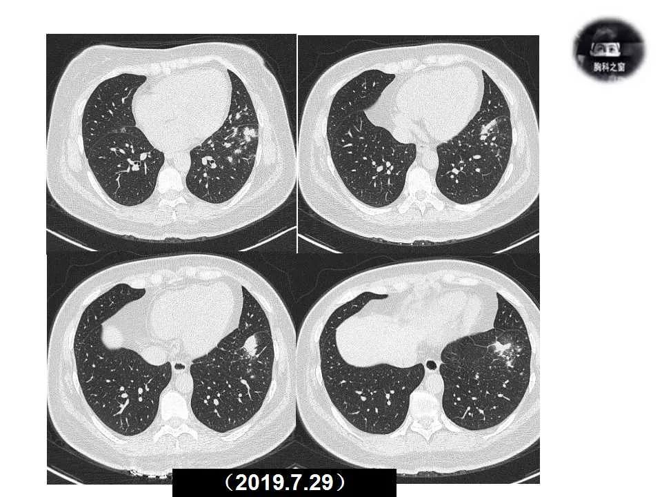 双肺多发结节是肺癌的征兆吗,双肺多发结节灶