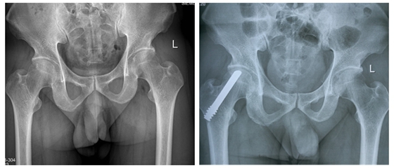 3d打印人工股骨头关节最新技术,3d打印人工骨再造脚趾