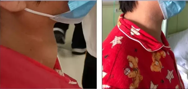 甲状腺结节开刀还是消融手术好,甲状腺结节什么条件符合消融手术